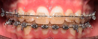 Deckbiss Behandlung feste Zahnspange - Multiband in Situ