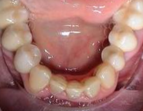 Gerade Zähne mit Zahnersatz
