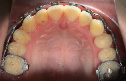 Kreuzbiss Behandlung mit fester Zahnspange - Multiband