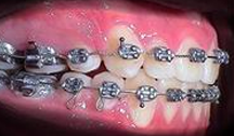 Offener Biss Behandlung mit fester Zahnspange