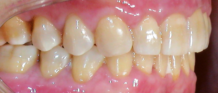 Zahnlücken nach Behandlung rechte Seite
