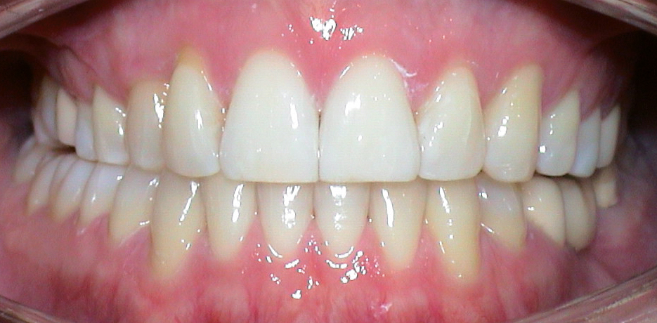 Kreuzbiss Prof. Dr. Polzar KKU