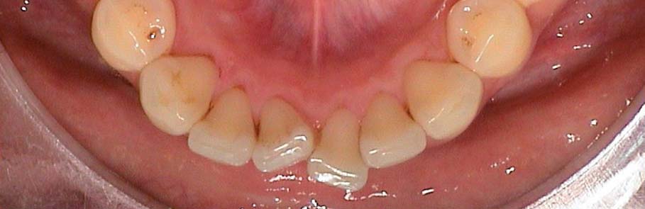 Progenie vor der Behandlung Unterkieferansicht