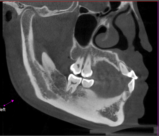 DVT in parasagittal exzentrischer Schnittebene