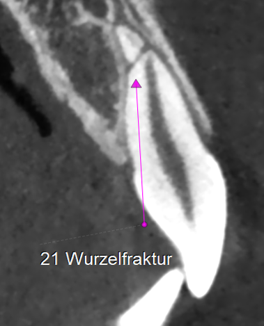 DVT 19 Wurzelfraktion