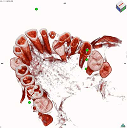 DVT Distopalatinal