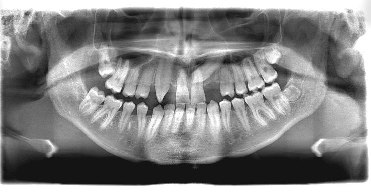 Orthopanthomogramm