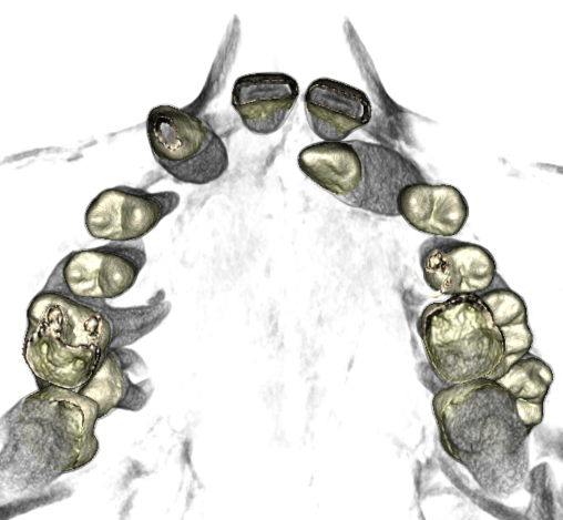 DVT in transversaler Ebene