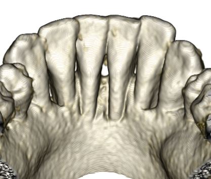 DVT Aufnahme Entfernung des Retainers