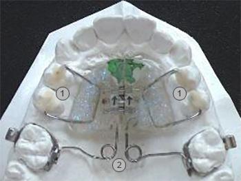 Pendulum (Distalisierungs) Apparatur zur Engstand Patientenbeispiel