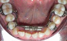Behandlung vor fester Zahnspange mit Multibandbehandlung