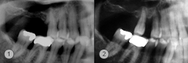 Distal Jet Röntgenbilder Zahnfehlstellung