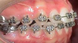 Brackets Zahnspange