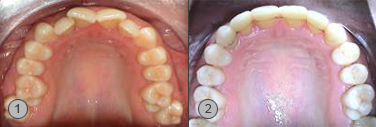 Vor und Nachher Bilder KFO Behandlung ohne Zähne ziehen