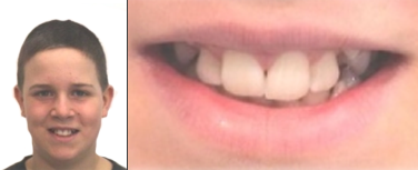 Patientenbeispiel ohne Zähne ziehen