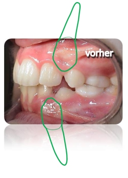 Vor Zahnkorrektur