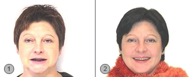 Vor und Nachher Bilder Vorverlagerung chirurischen Eingriff