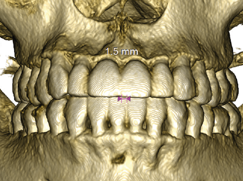 DVT Frontal