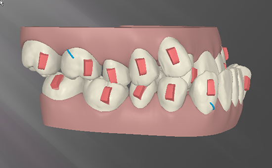 Attachements