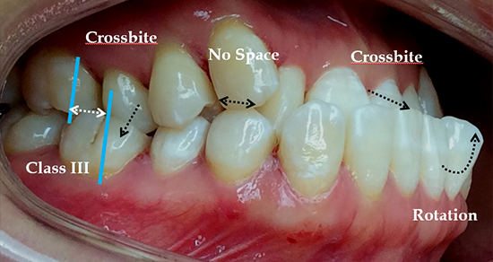 Intraoral rechts vor Therapie