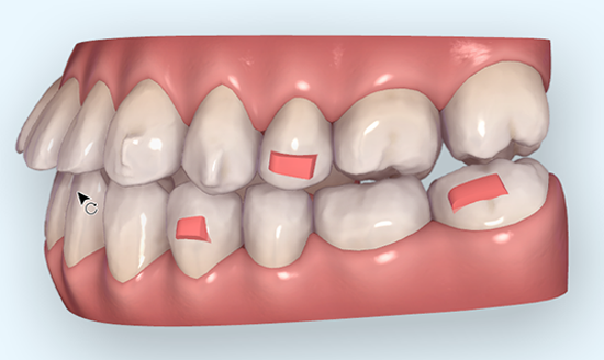 Case Refinement