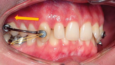 Patientenbeispiel Distal Carriere