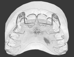 Progenie, Vorbiss Behandlung mit herausnehmbare Zahnspange