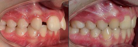 Zahnlücke und Nichtanlage nach Behandlung